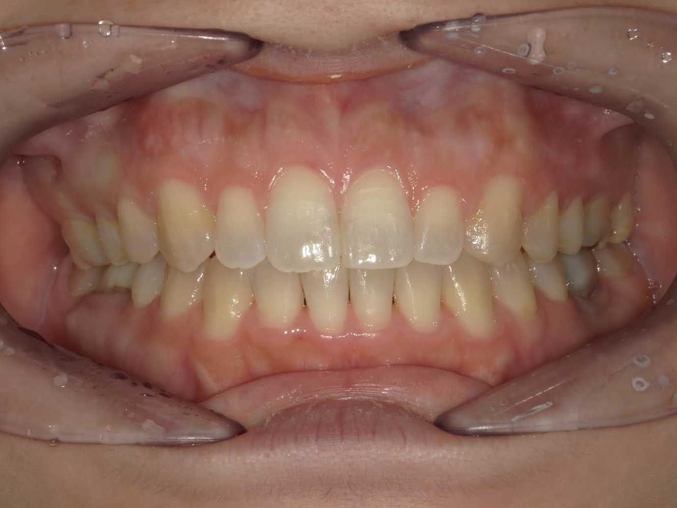 すきっ歯の表側矯正の症例After