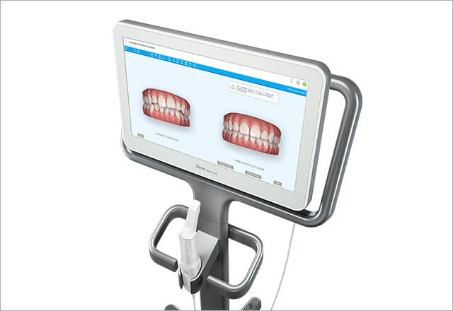 iTeroと歯科用3Dプリンターを導入