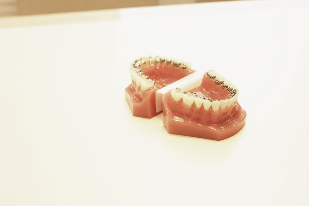 歯列矯正の期間はどのくらい？長くかかってしまう人の特徴とは？