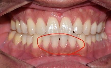 歯列矯正後に歯茎が下がる「歯肉退縮」とは？