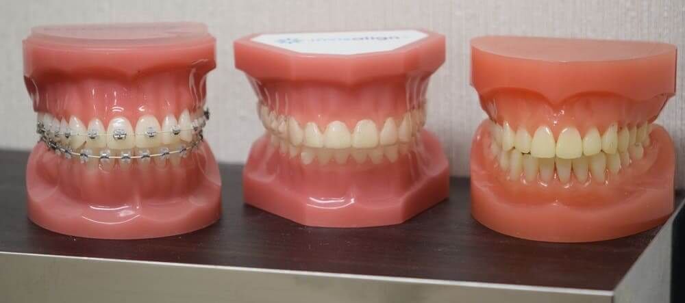歯列矯正にはどんな種類がある？自分にあった矯正を選ぶポイント