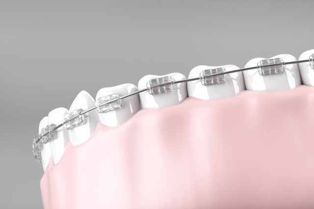 歯列矯正にかかる期間の目安・治療期間と短くするためのポイント