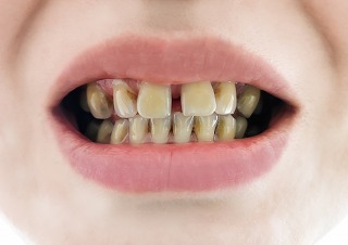 変色した歯