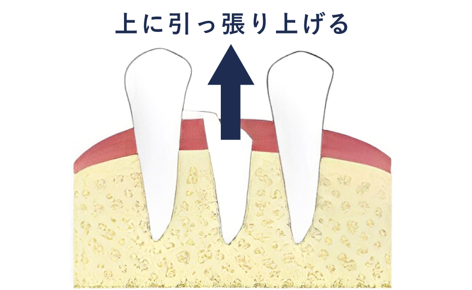 虫歯