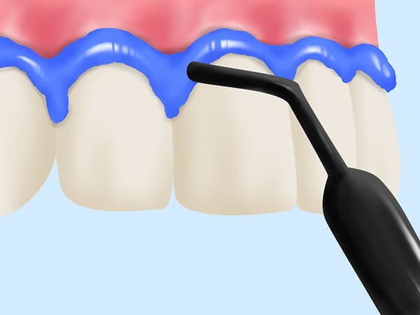 Step 02 歯ぐきの保護