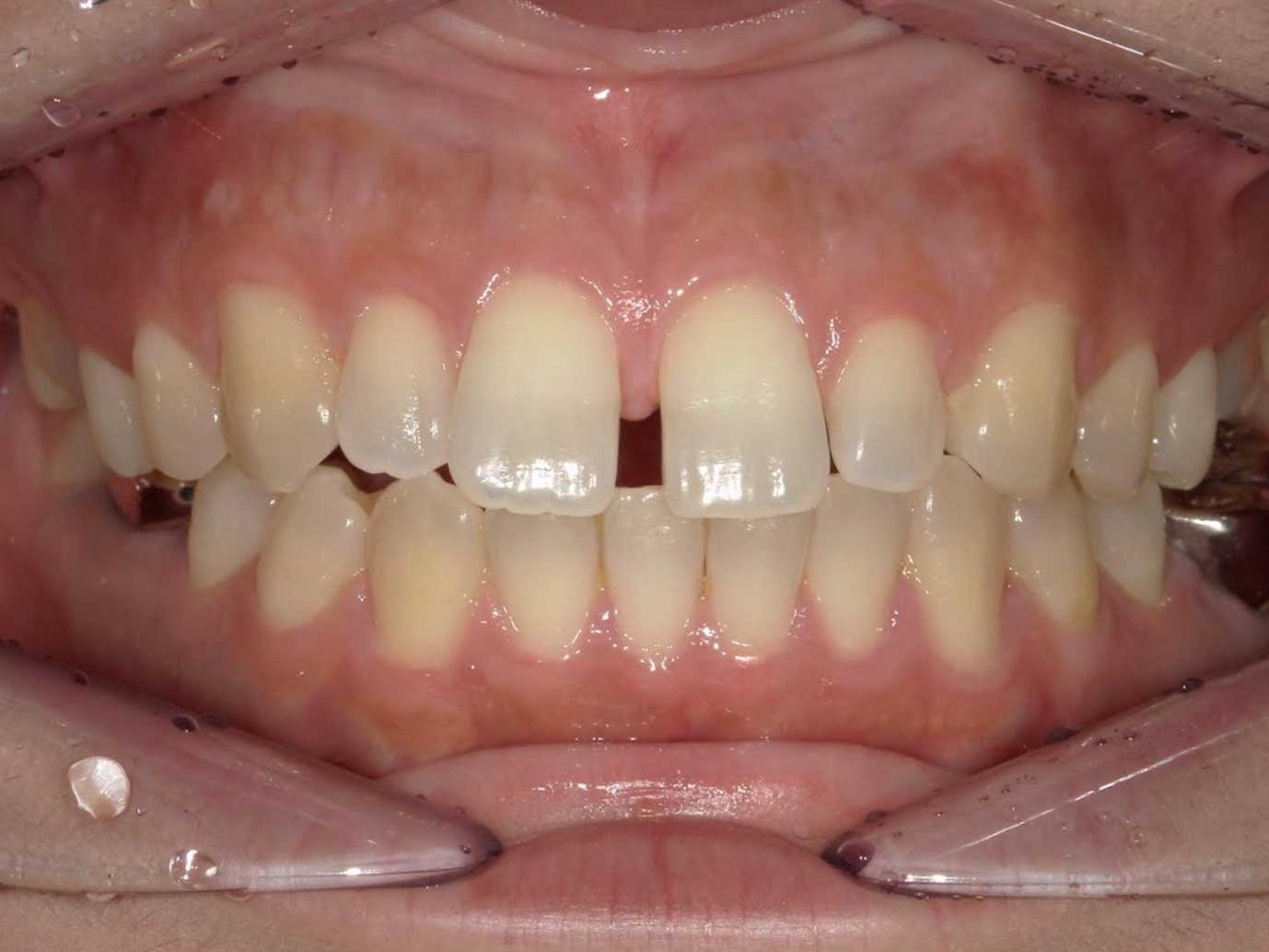 すきっ歯の表側矯正の症例Before