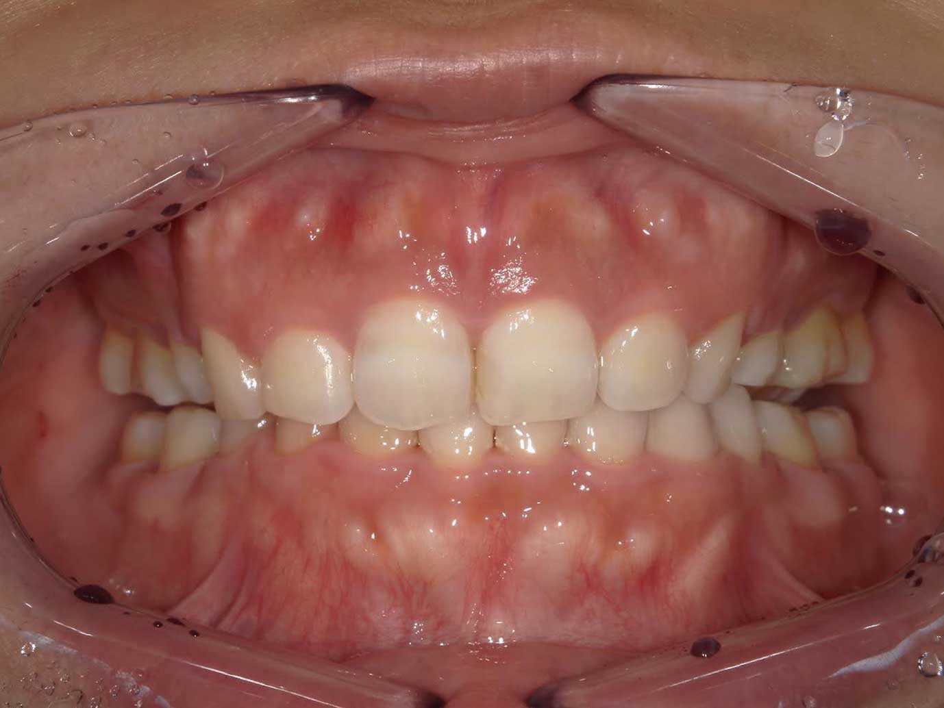 過顎咬合の表側矯正の症例Before
