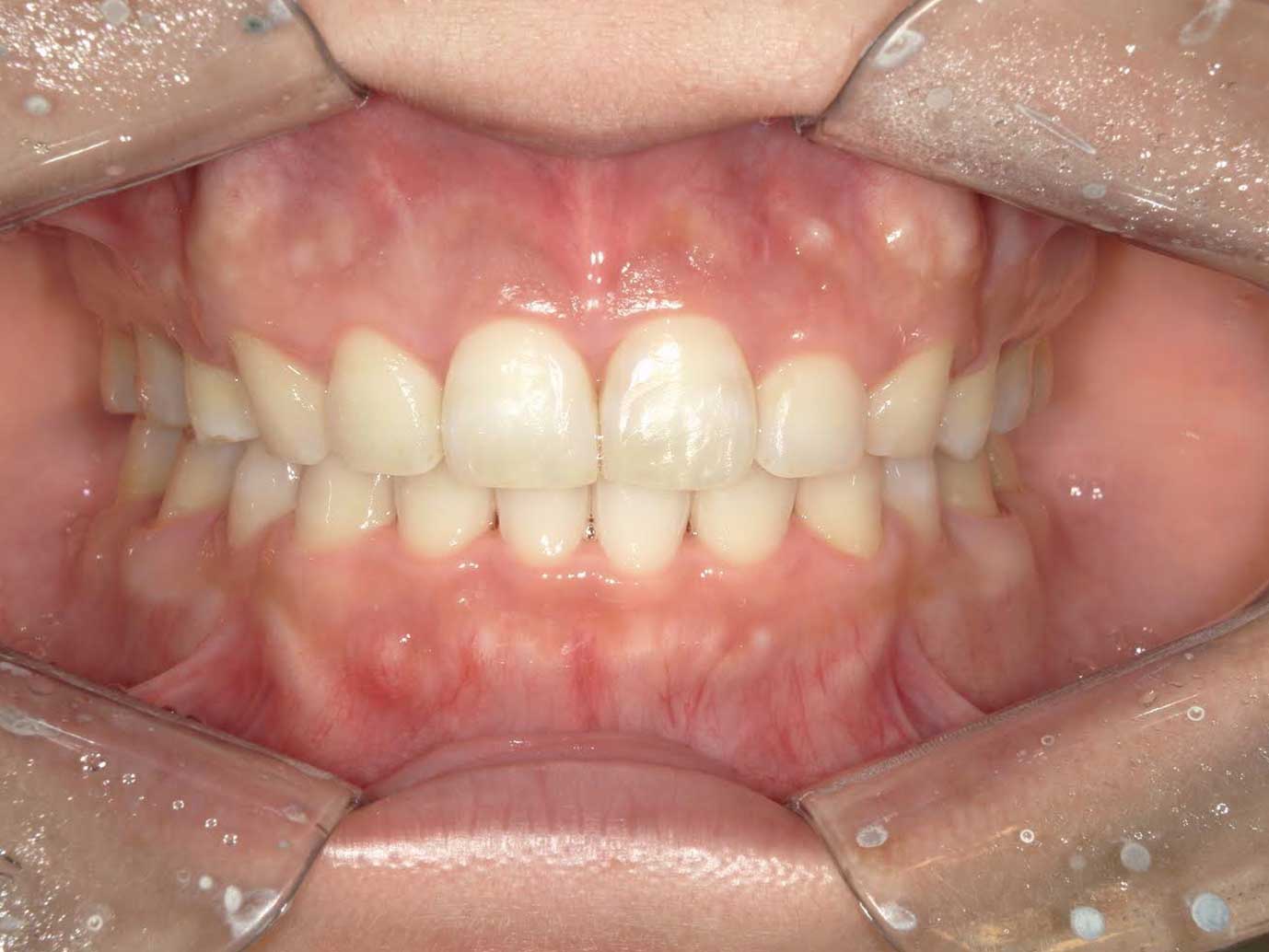 過顎咬合の表側矯正の症例After