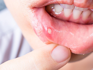 口内炎とは