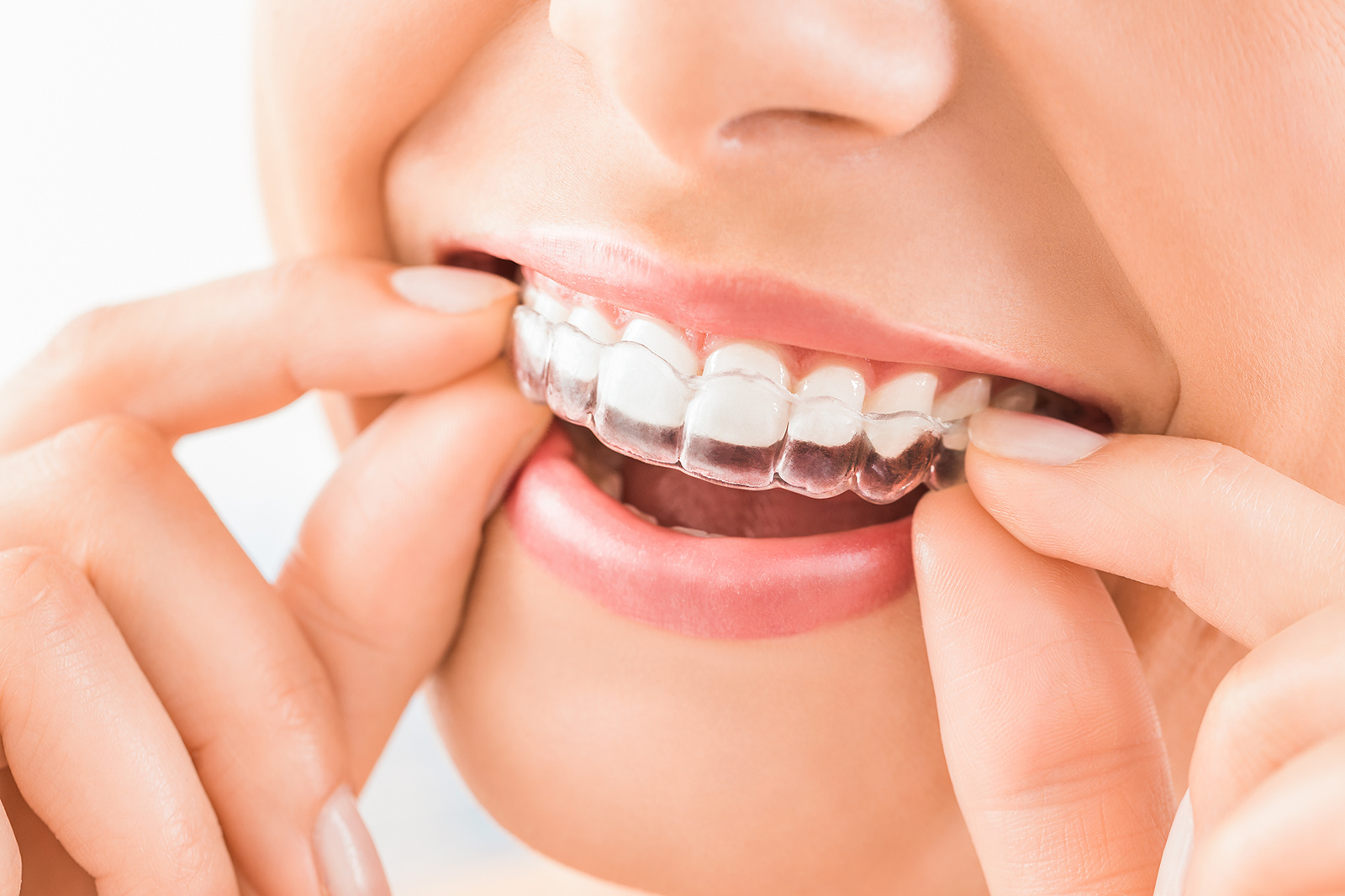 マウスピースの画像