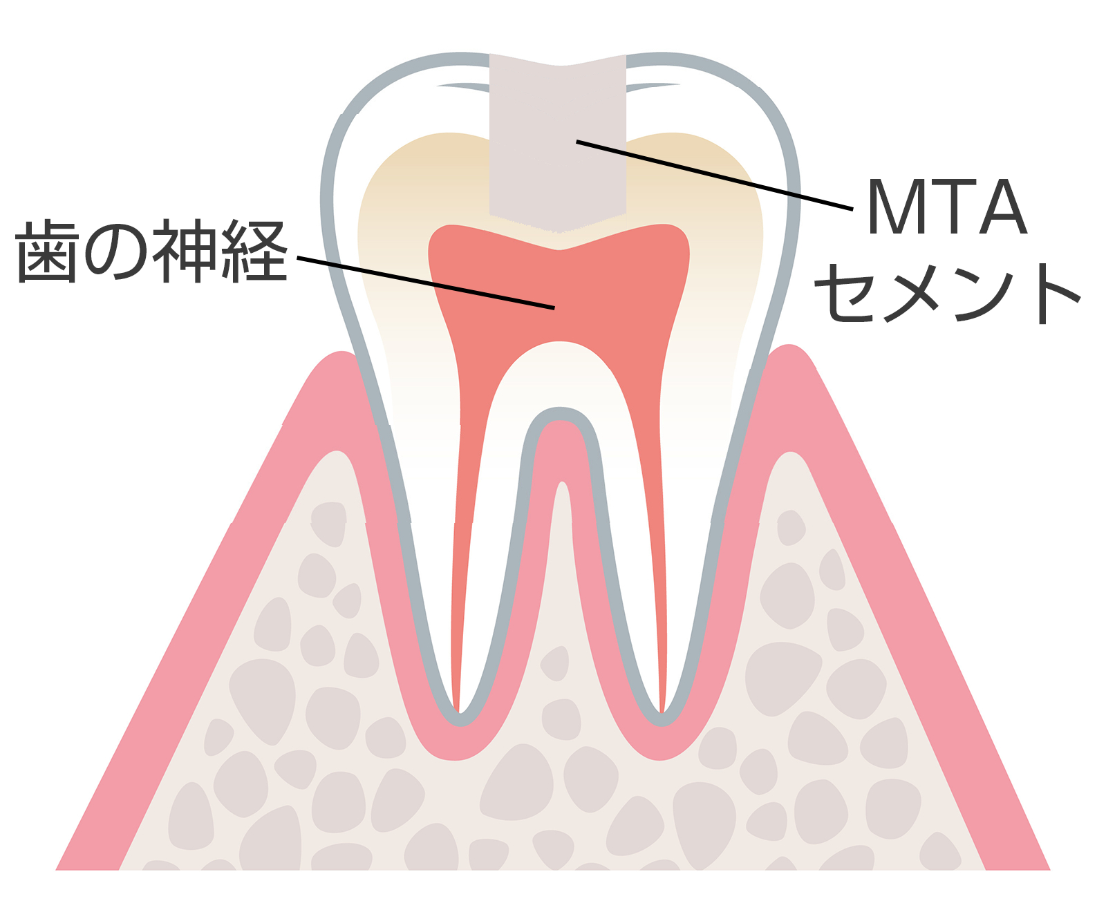 間接覆髄法