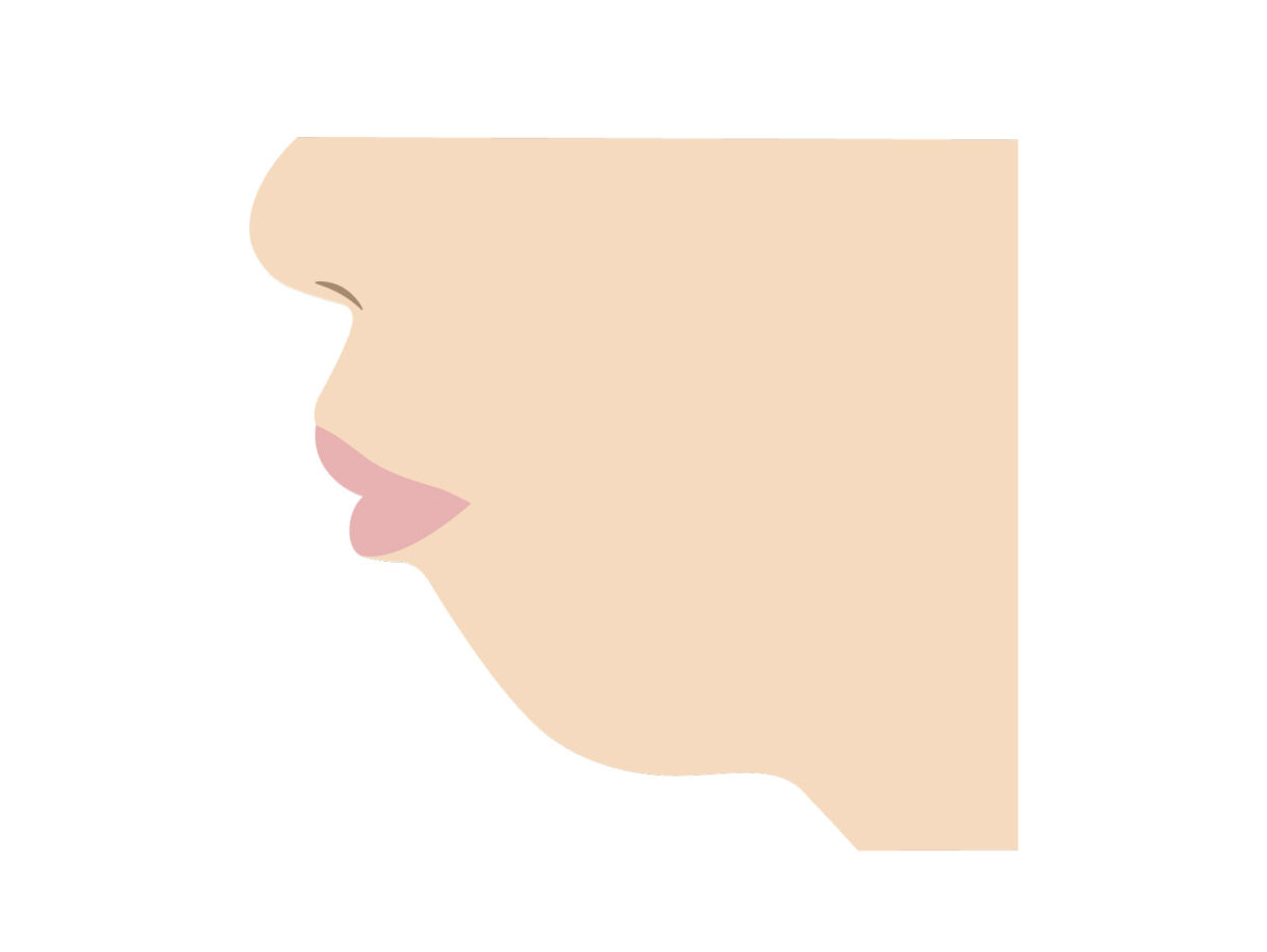 アデノイド顔貌