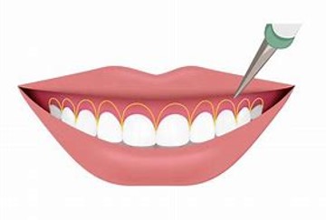 歯冠長延長術 (1)