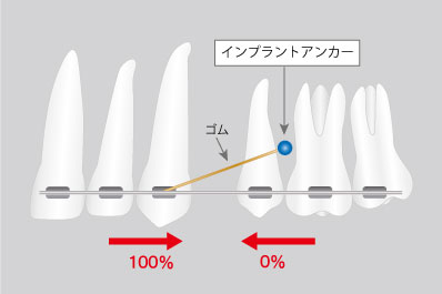 インプラントアンカー