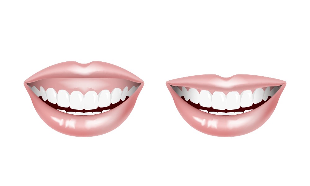 ガミースマイル(前後)